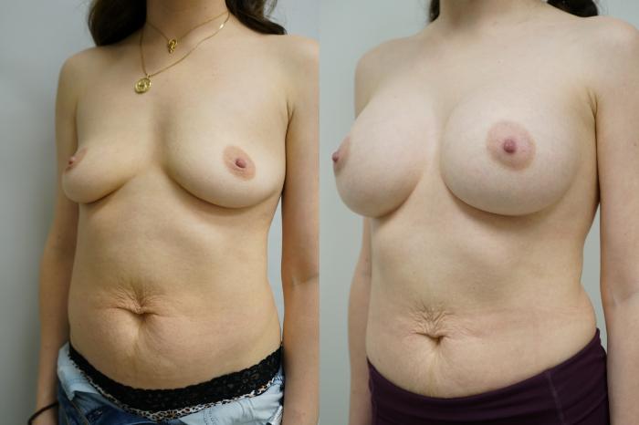 Before & After Breast Augmentation Case 357 Left Oblique View in Gilbert, AZ