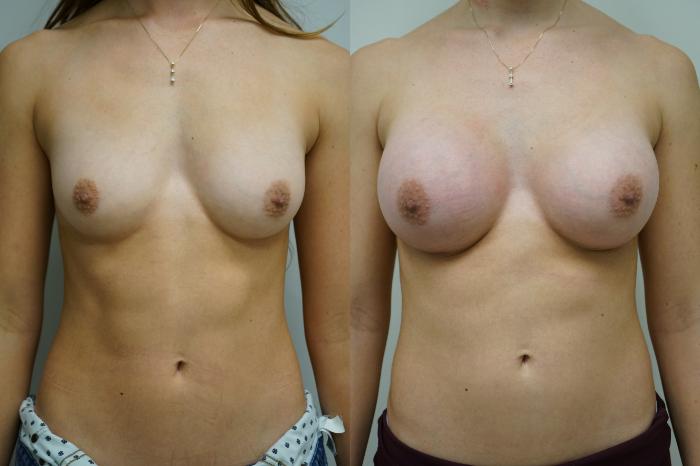 Before & After Breast Augmentation Case 358 Front View in Gilbert, AZ