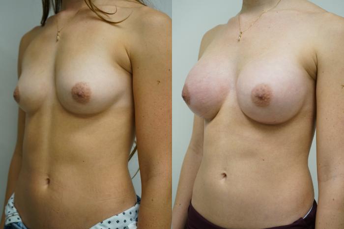 Before & After Breast Augmentation Case 358 Left Oblique View in Gilbert, AZ