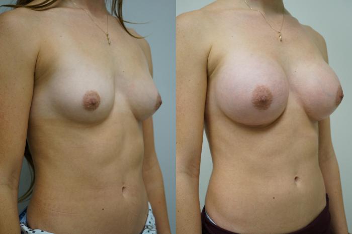 Before & After Breast Augmentation Case 358 Right Oblique View in Gilbert, AZ