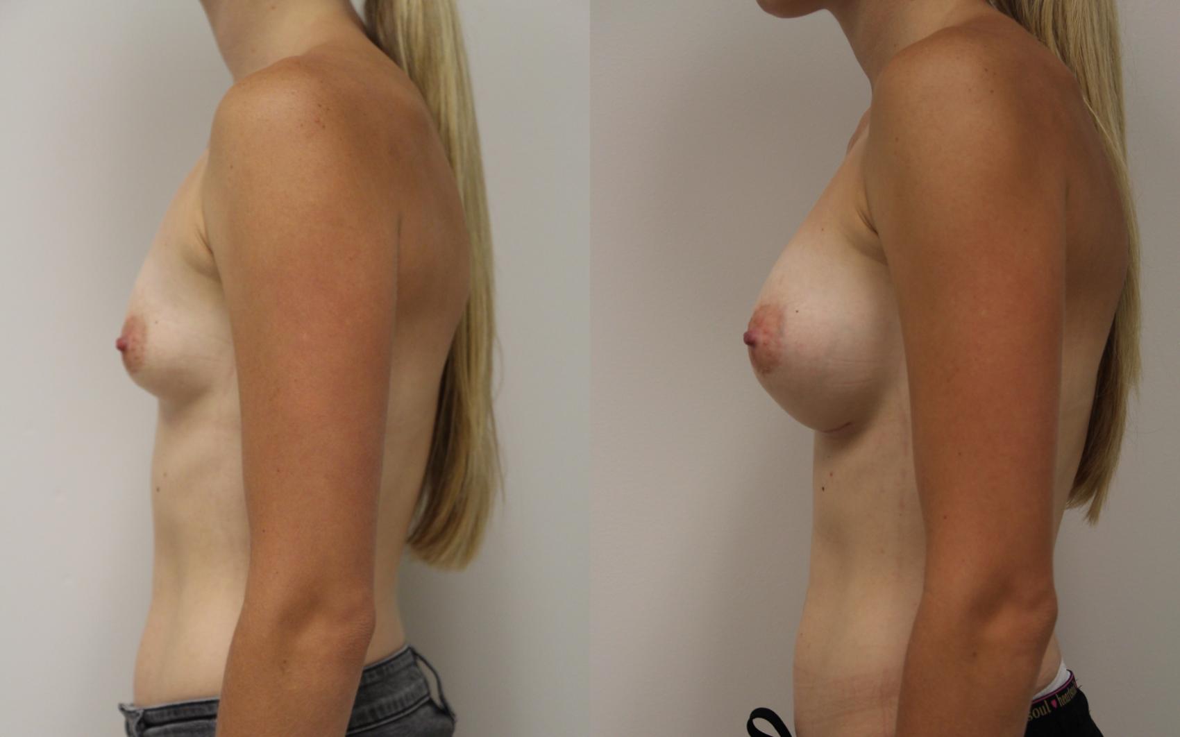 Before & After Breast Augmentation Case 36 View #1 View in Gilbert, AZ