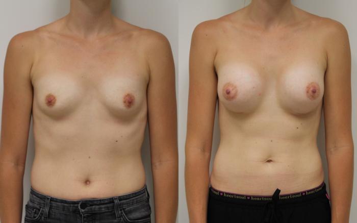 Before & After Breast Augmentation Case 36 View #2 View in Gilbert, AZ