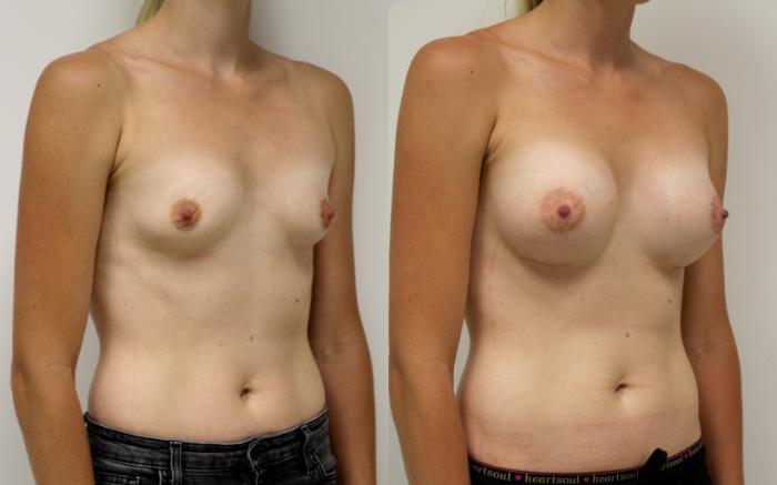 Before & After Breast Augmentation Case 36 View #3 View in Gilbert, AZ