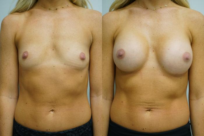 Before & After Breast Augmentation Case 360 Front View in Gilbert, AZ