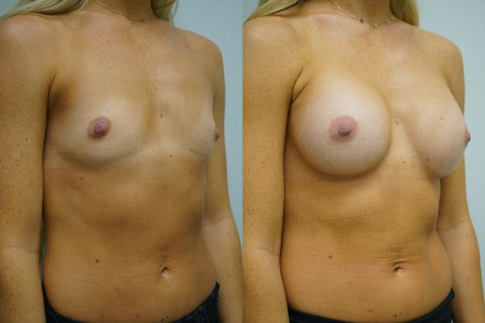 Before & After Breast Augmentation Case 360 Right Oblique View in Gilbert, AZ