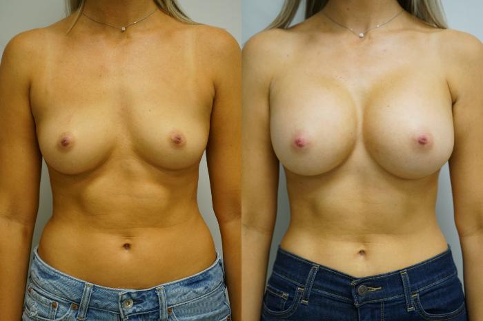 Before & After Breast Augmentation Case 361 Front View in Gilbert, AZ