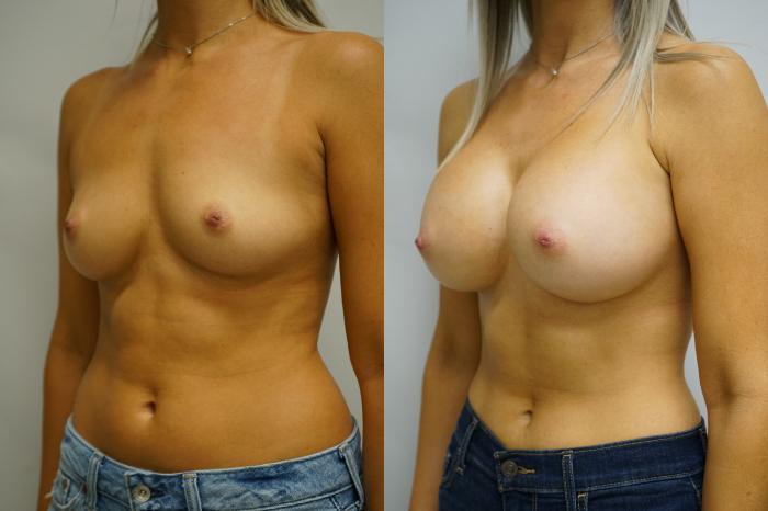 Before & After Breast Augmentation Case 361 Left Oblique View in Gilbert, AZ