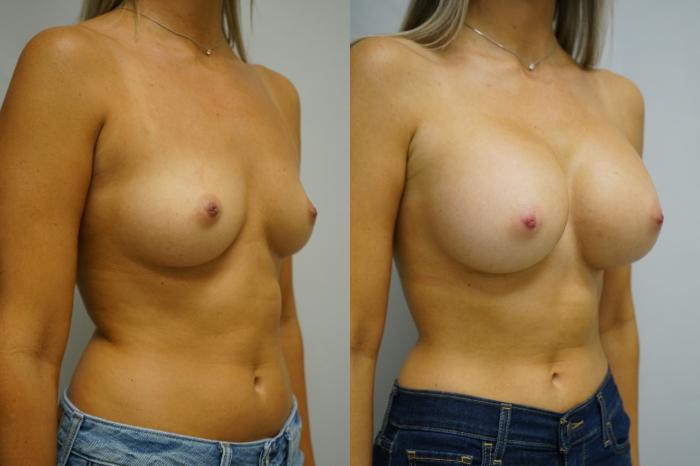 Before & After Breast Augmentation Case 361 Right Oblique View in Gilbert, AZ