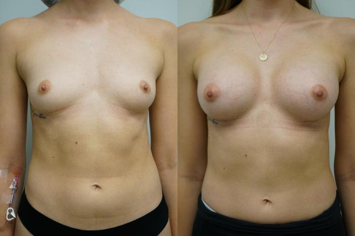 Before & After Breast Augmentation Case 362 Front View in Gilbert, AZ