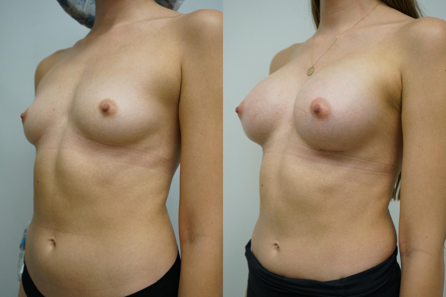Before & After Breast Augmentation Case 362 Left Oblique View in Gilbert, AZ