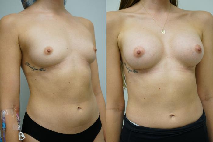 Before & After Breast Augmentation Case 362 Right Oblique View in Gilbert, AZ