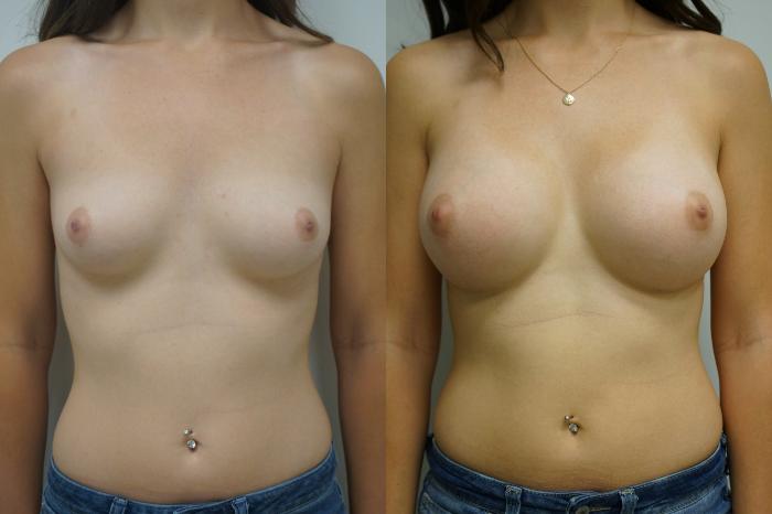 Before & After Breast Augmentation Case 363 Front View in Gilbert, AZ