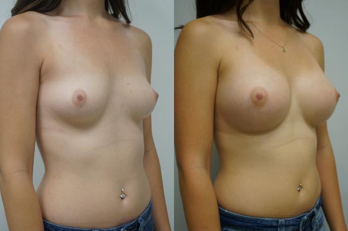 Before & After Breast Augmentation Case 363 Right Oblique View in Gilbert, AZ