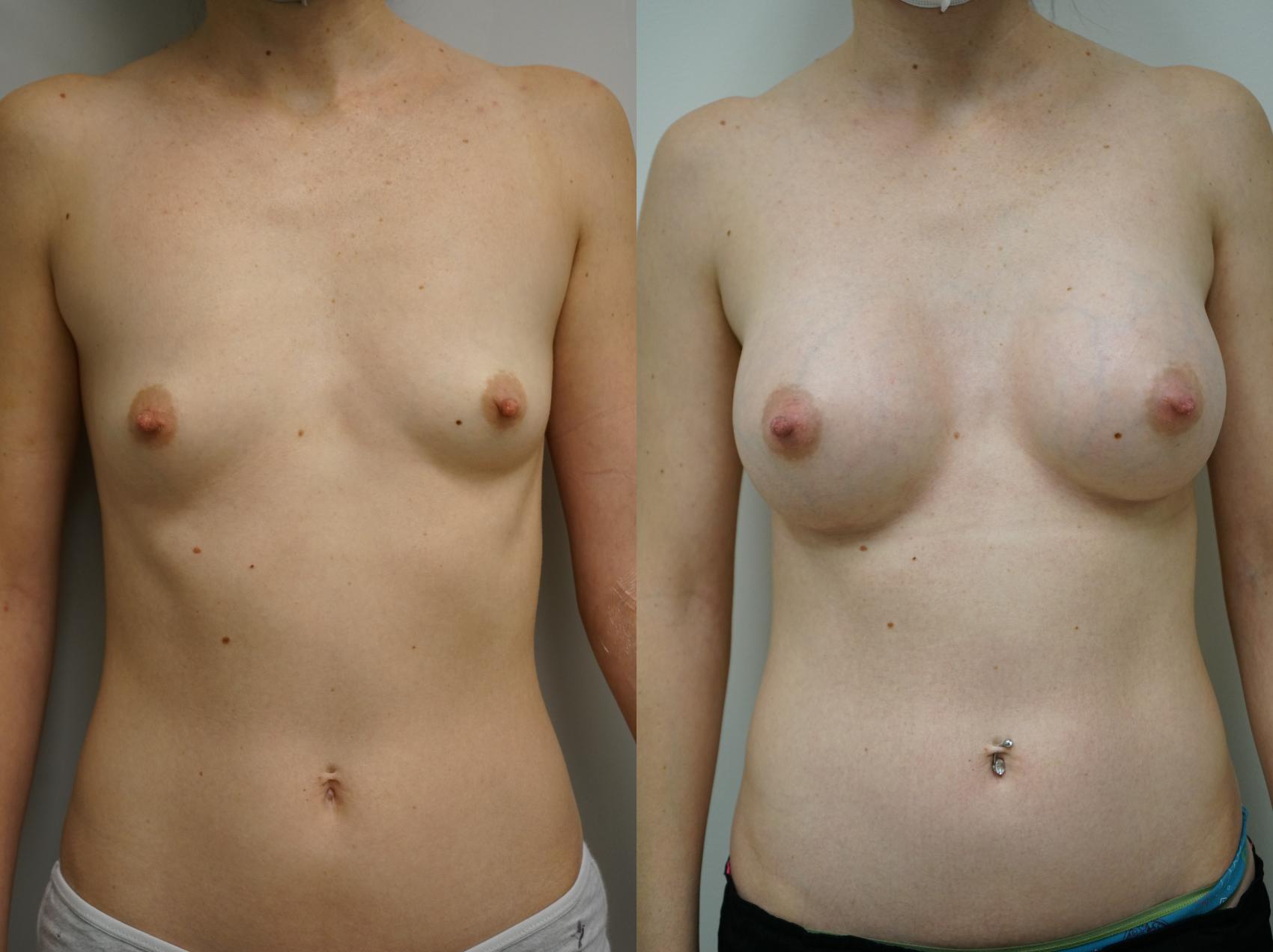 Before & After Breast Augmentation Case 364 Front View in Gilbert, AZ
