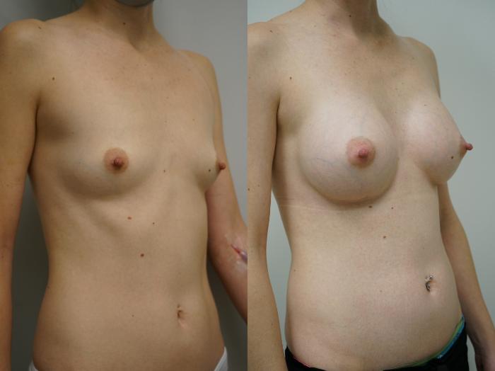 Before & After Breast Augmentation Case 364 Right Oblique View in Gilbert, AZ