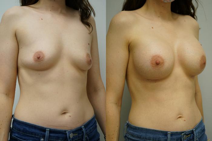 Before & After Breast Augmentation Case 367 Right Oblique View in Gilbert, AZ