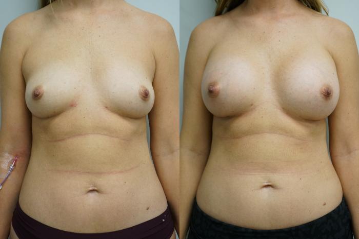 Before & After Breast Augmentation Case 370 Front View in Gilbert, AZ