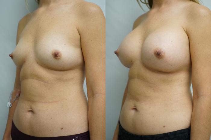 Before & After Breast Augmentation Case 370 Left Oblique View in Gilbert, AZ