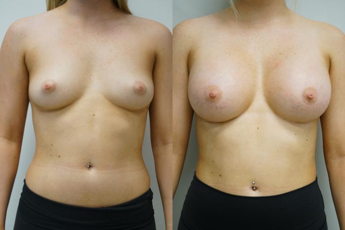 Before & After Breast Augmentation Case 373 Front View in Gilbert, AZ