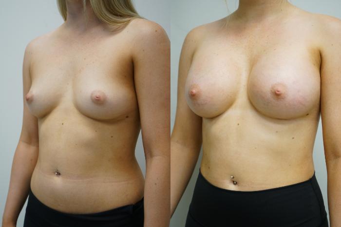 Before & After Breast Augmentation Case 373 Left Oblique View in Gilbert, AZ