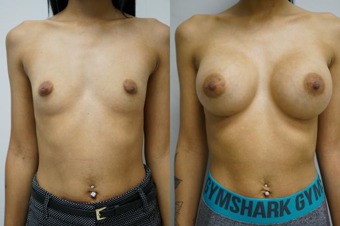 Before & After Breast Augmentation Case 375 Front View in Gilbert, AZ