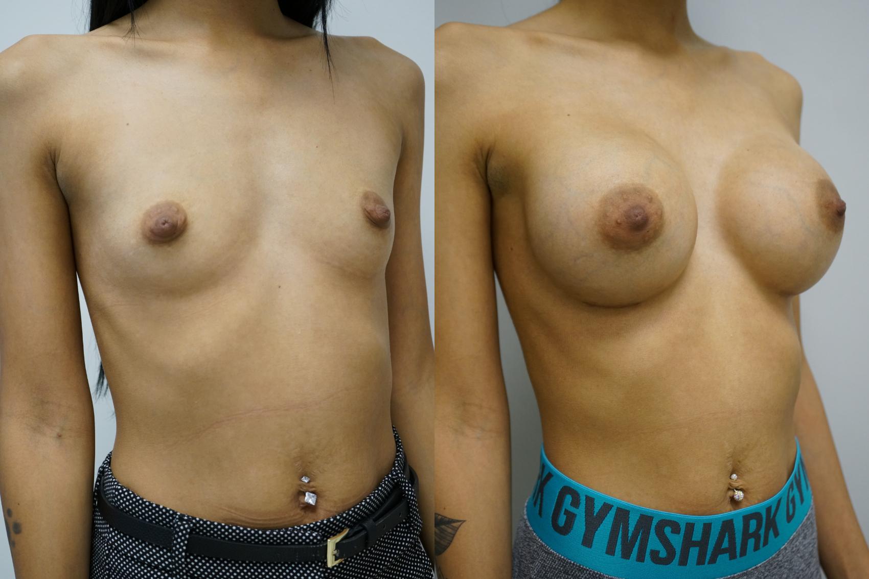 Before & After Breast Augmentation Case 375 Right Oblique View in Gilbert, AZ