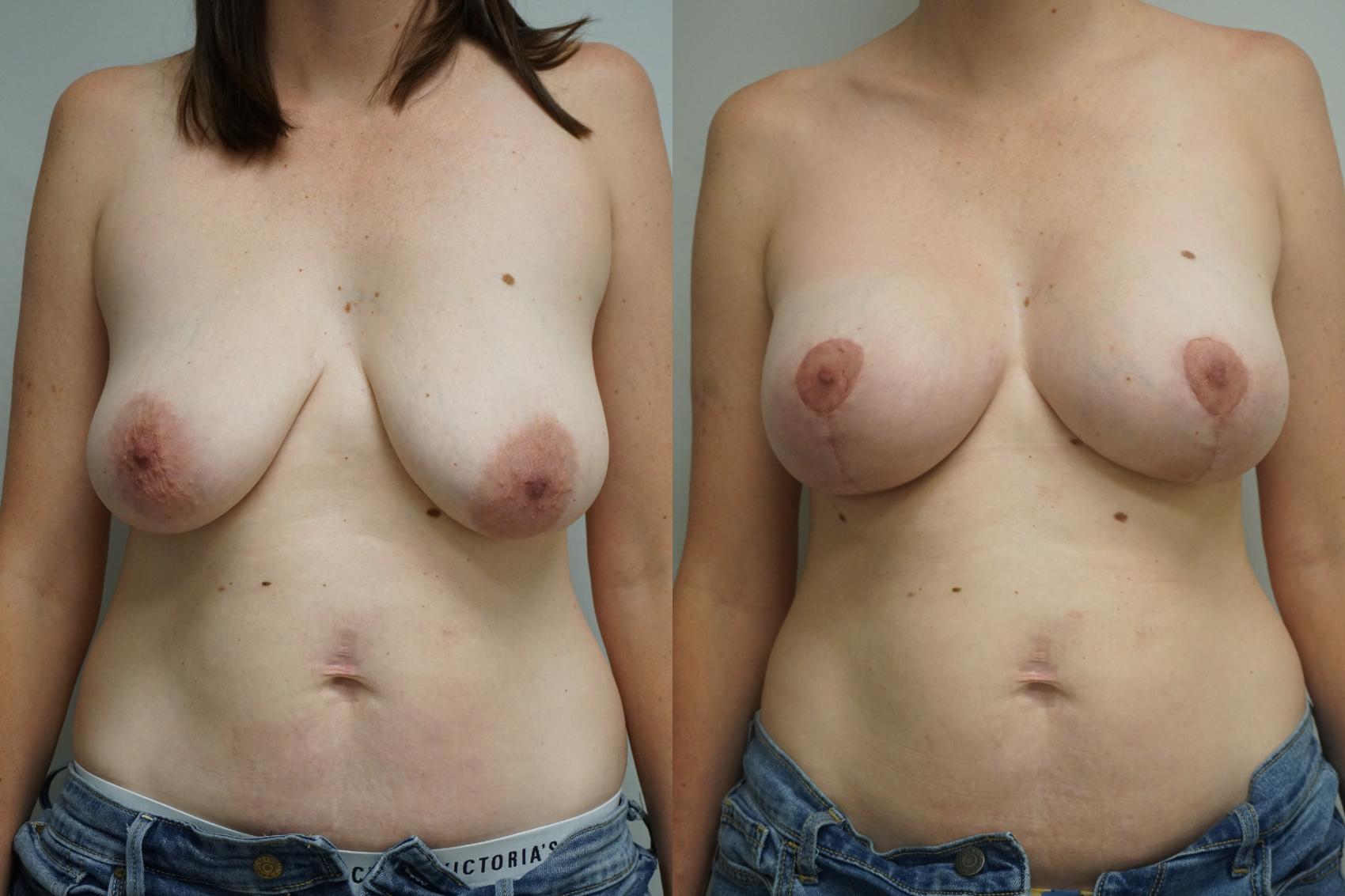 Before & After Breast Augmentation Case 376 Front View in Gilbert, AZ