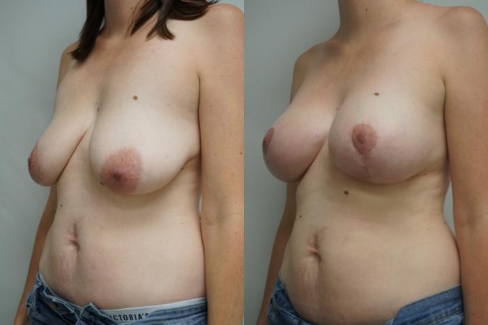 Before & After Breast Augmentation Case 376 Left Oblique View in Gilbert, AZ