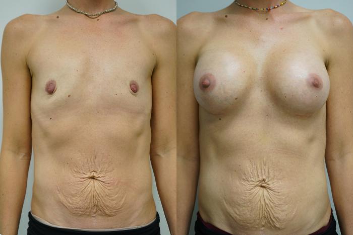 Before & After Breast Augmentation Case 377 Front View in Gilbert, AZ