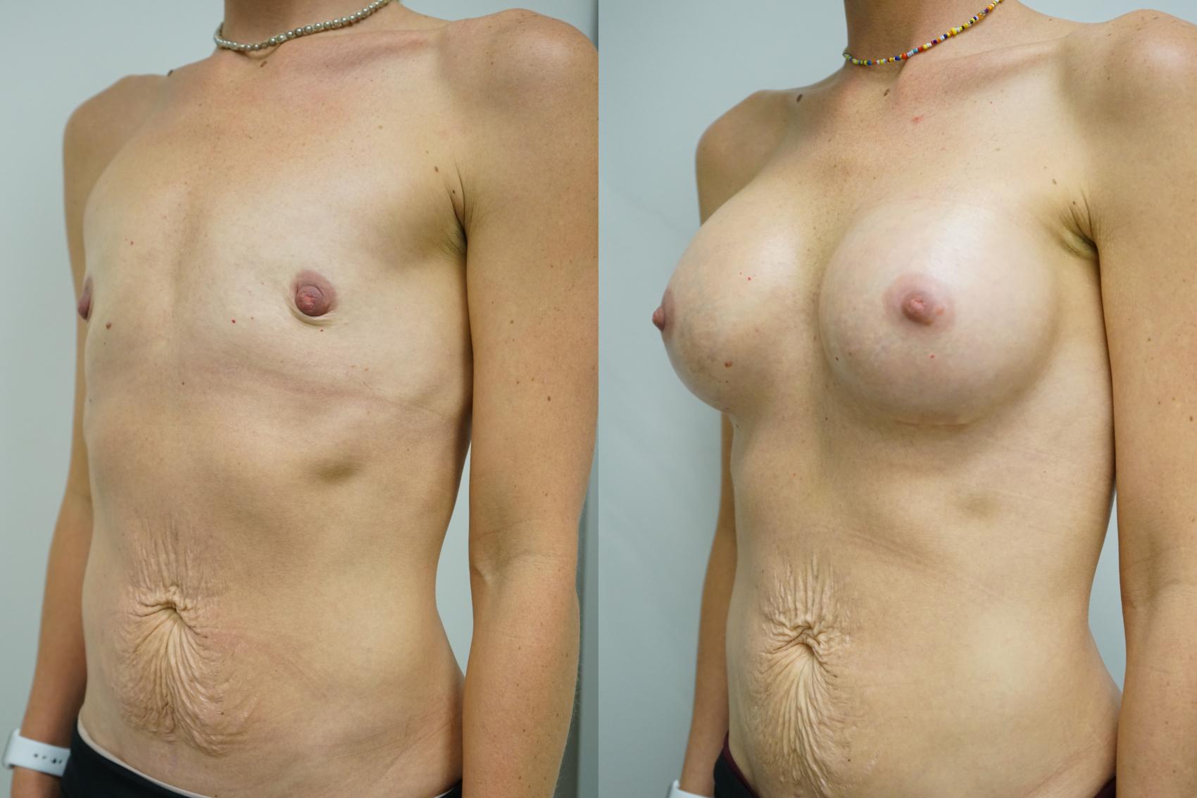 Before & After Breast Augmentation Case 377 Left Oblique View in Gilbert, AZ