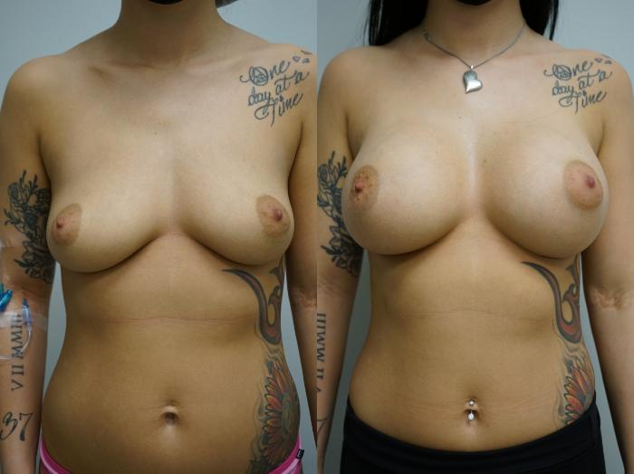 Before & After Breast Augmentation Case 379 Front View in Gilbert, AZ