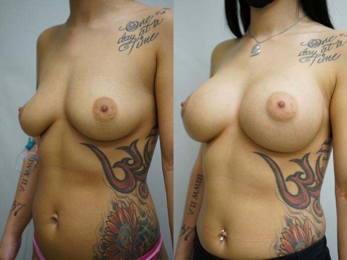 Before & After Breast Augmentation Case 379 Left Oblique View in Gilbert, AZ