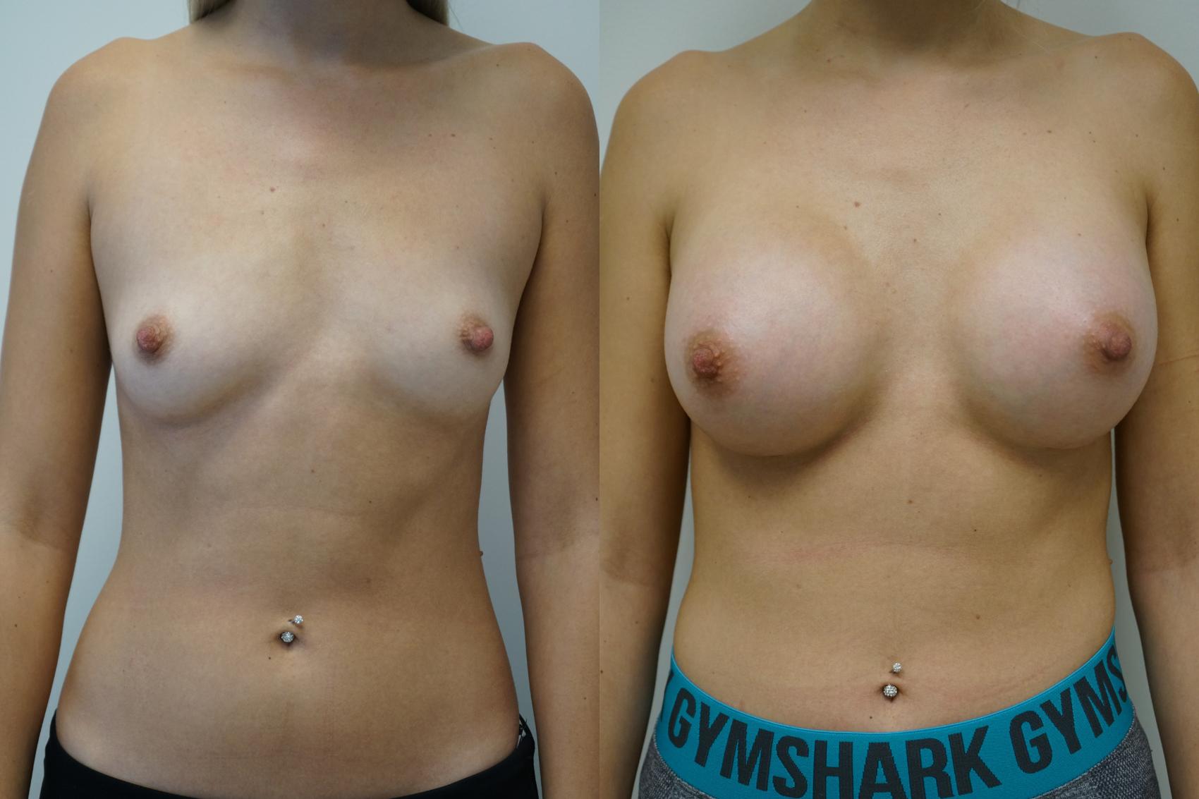 Before & After Breast Augmentation Case 381 Front View in Gilbert, AZ