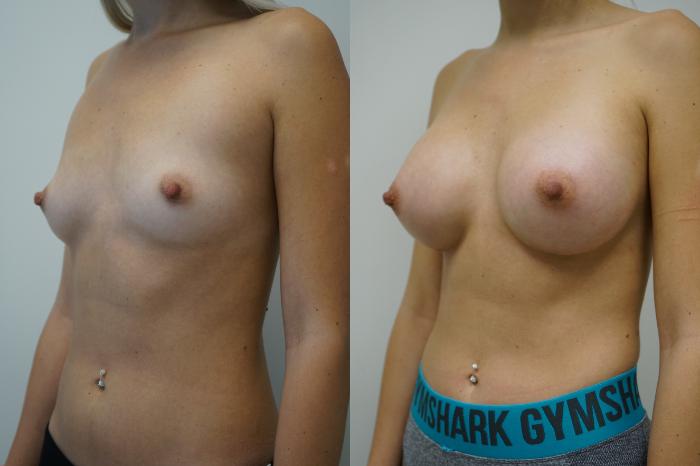 Before & After Breast Augmentation Case 381 Left Oblique View in Gilbert, AZ