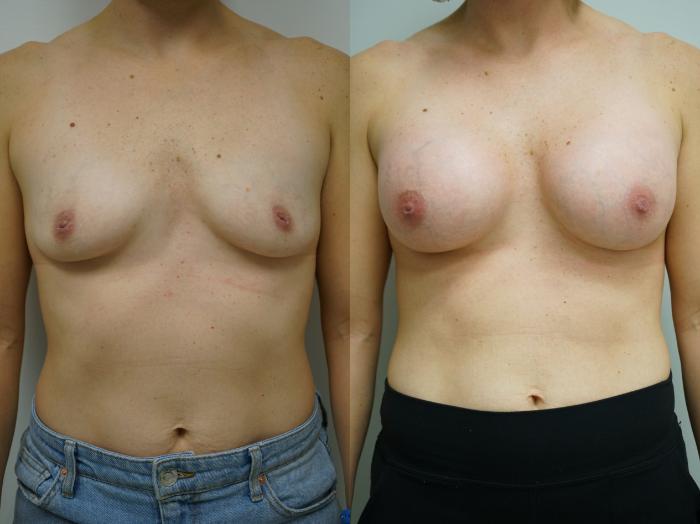 Before & After Breast Augmentation Case 383 Front View in Gilbert, AZ