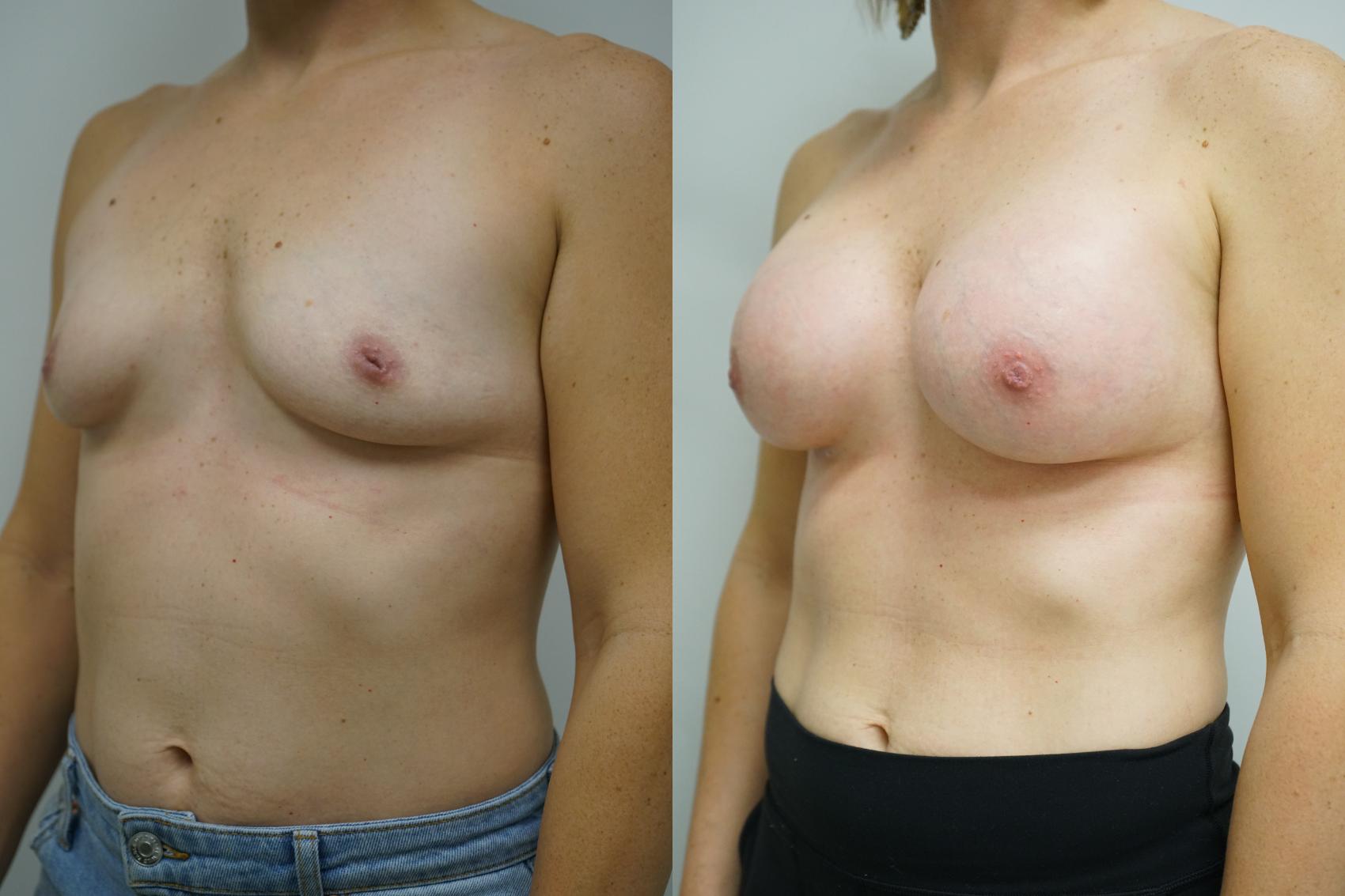 Before & After Breast Augmentation Case 383 Left Oblique View in Gilbert, AZ