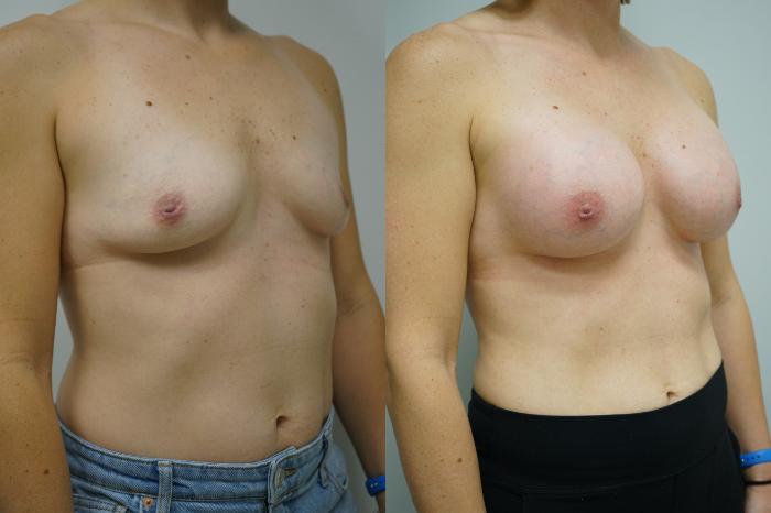 Before & After Breast Augmentation Case 383 Right Oblique View in Gilbert, AZ
