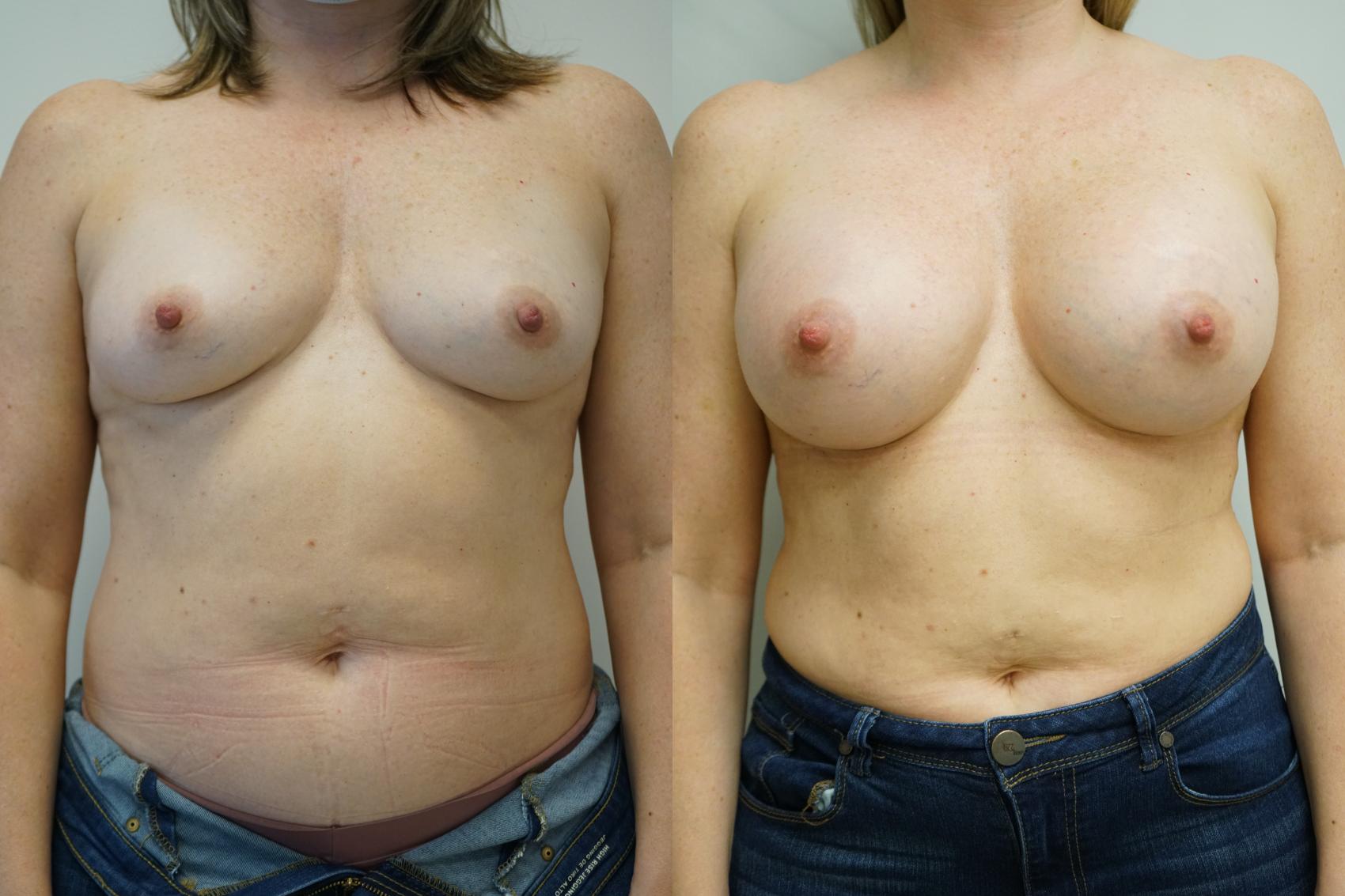 Before & After Breast Augmentation Case 385 Front View in Gilbert, AZ