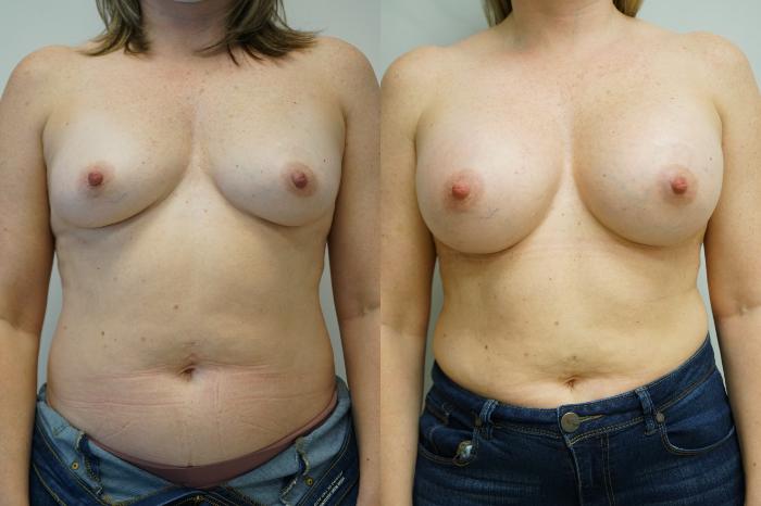Before & After Breast Augmentation Case 385 Front View in Gilbert, AZ