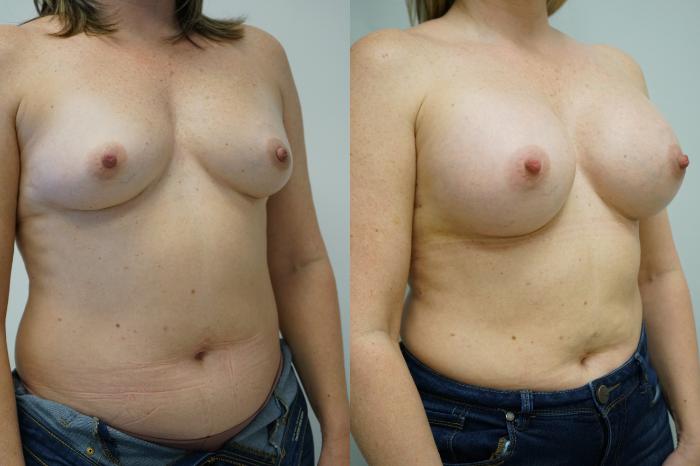 Before & After Breast Augmentation Case 385 Right Oblique View in Gilbert, AZ