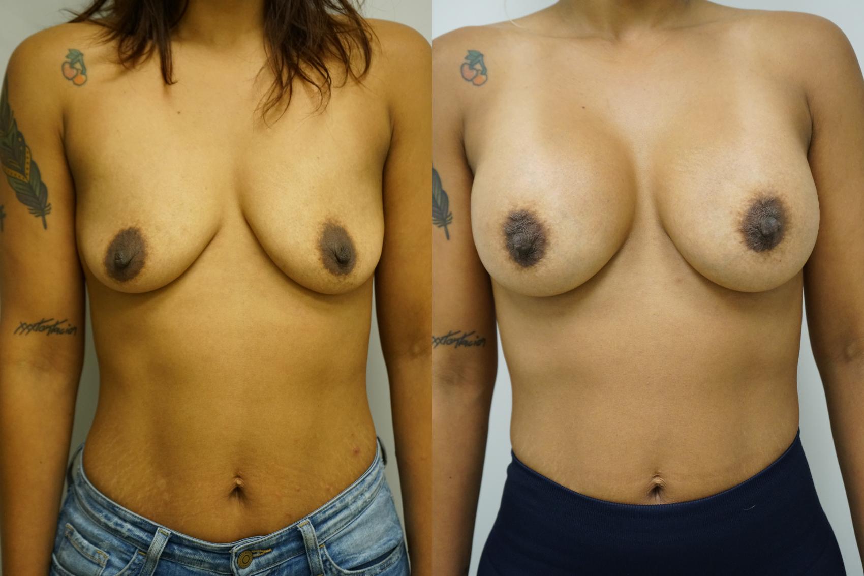 Before & After Breast Augmentation Case 386 Front View in Gilbert, AZ