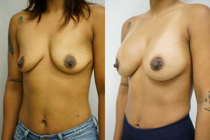 Before & After Breast Augmentation Case 386 Left Oblique View in Gilbert, AZ