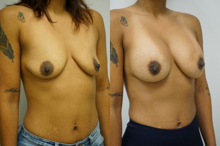 Before & After Breast Augmentation Case 386 Right Oblique View in Gilbert, AZ