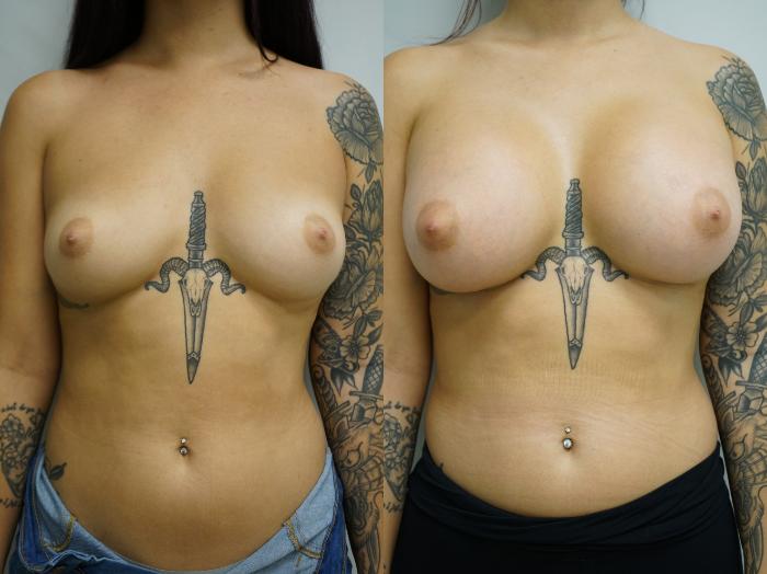 Before & After Breast Augmentation Case 389 Front View in Gilbert, AZ