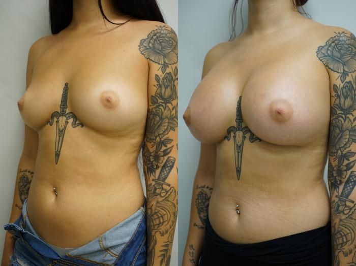 Before & After Breast Augmentation Case 389 Left Oblique View in Gilbert, AZ