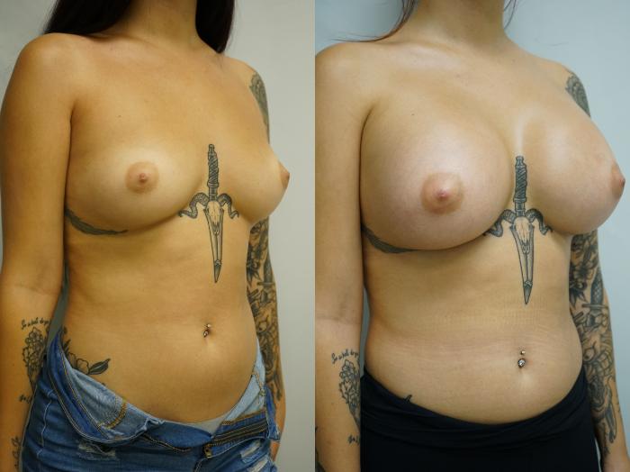 Before & After Breast Augmentation Case 389 Right Oblique View in Gilbert, AZ