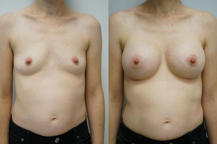 Before & After Breast Augmentation Case 392 Front View in Gilbert, AZ