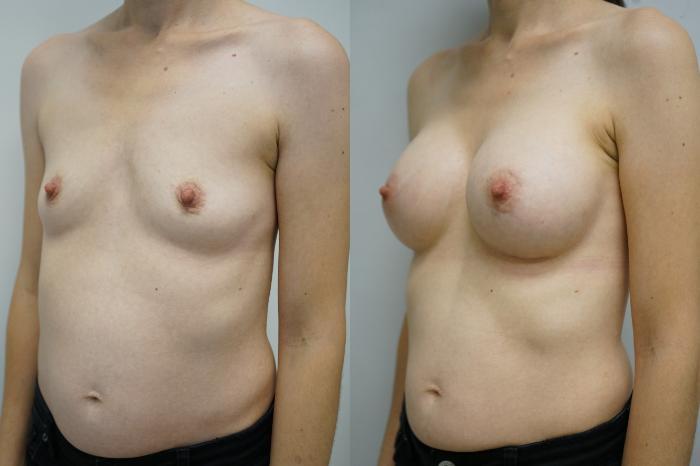 Before & After Breast Augmentation Case 392 Left Oblique View in Gilbert, AZ