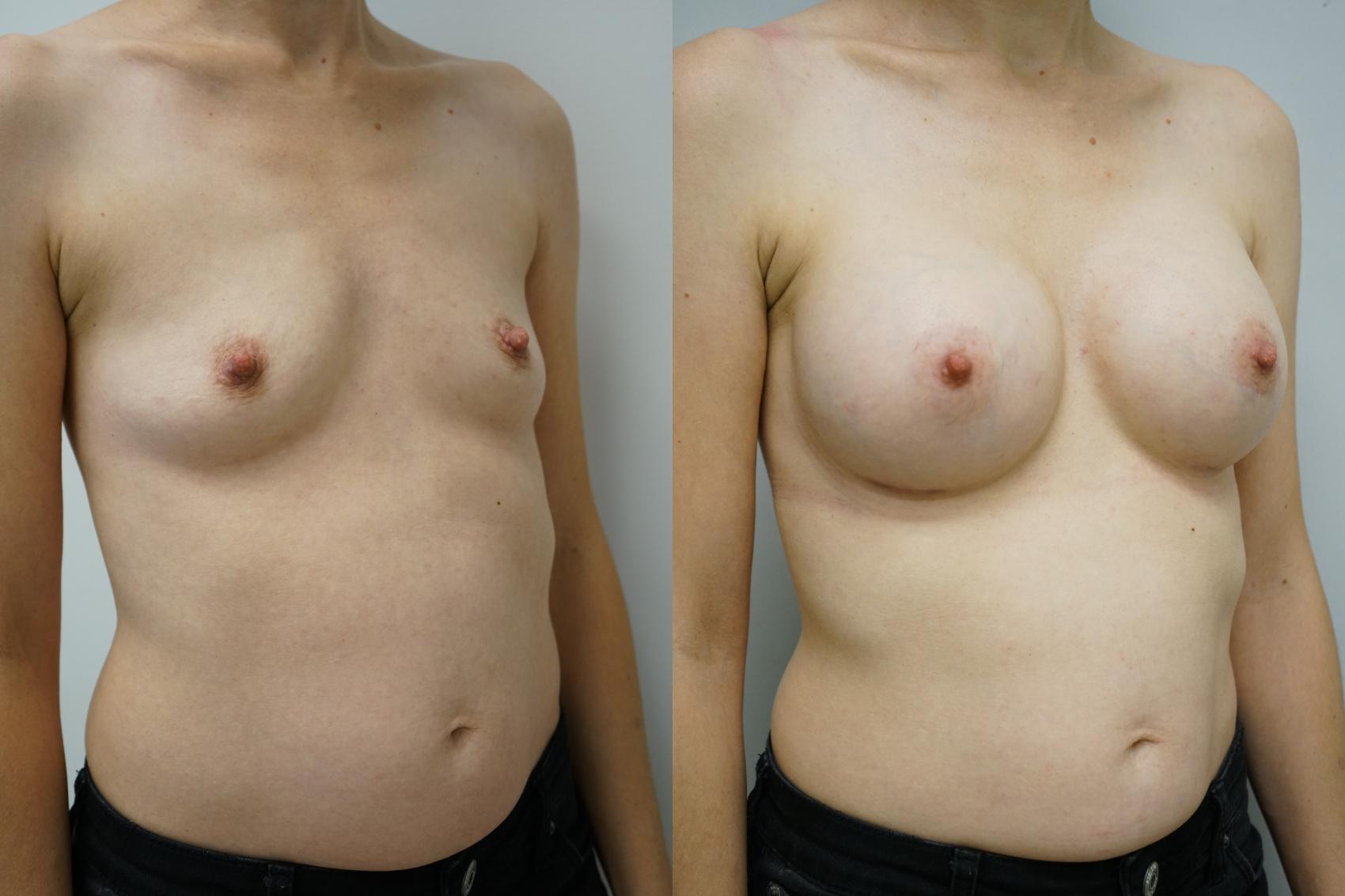 Before & After Breast Augmentation Case 392 Right Oblique View in Gilbert, AZ