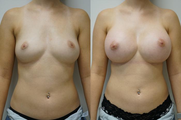 Before & After Breast Augmentation Case 393 Front View in Gilbert, AZ
